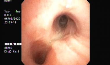 എട്ടുമാസം പ്രായമുള്ള ശിശുവിന്റെ ശ്വാസകോശത്തിൽ നിന്ന്  ഭക്ഷണത്തിന്റെ അംശങ്ങൾ നീക്കം ചെയ്തു