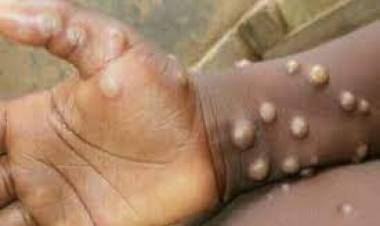 സംസ്ഥാനത്ത് ഒരാള്‍ക്ക് കൂടി കുരങ്ങുവസൂരി സ്ഥിരീകരിച്ച പശ്ചാത്തലത്തില്‍ പ്രതിരോധ പ്രവര്‍ത്തനങ്ങള്‍ ഊര്‍ജിതമാക്കി ആരോഗ്യവകുപ്പ്.